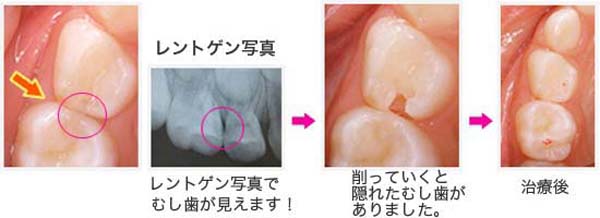 見逃しやすい歯と歯の間のむし歯