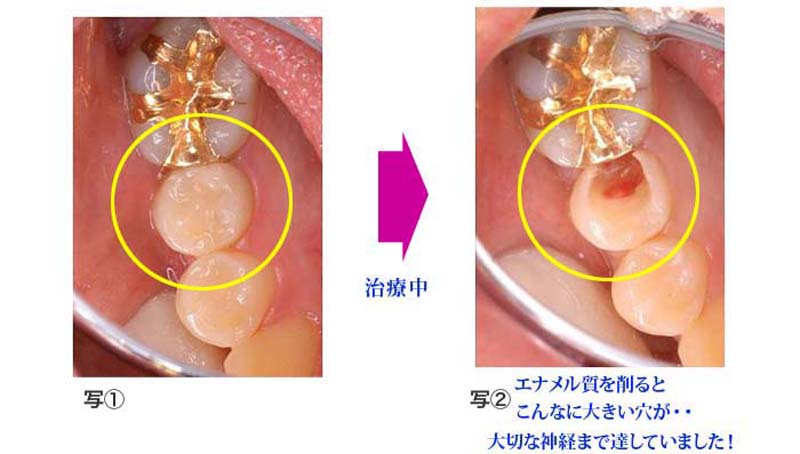 エナメル質を削ると神経まで達していたむし歯