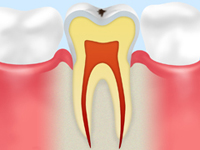 初期のむし歯