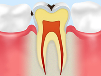 エナメル質のむし歯