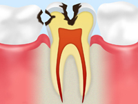 象牙質のむし歯