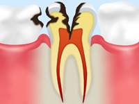 神経まで達したむし歯