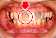 インプラント（1回法）001