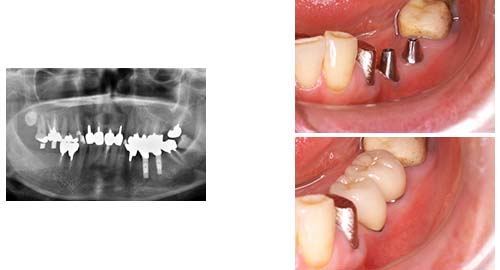 インプラント（2回法）001