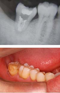 歯牙移植003