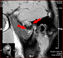 顎関節 MRI (閉口時)01