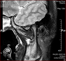 顎関節 MRI (閉口時)02