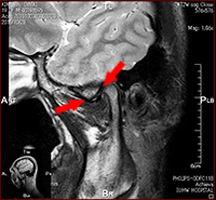 顎関節 MRI (閉口時)02