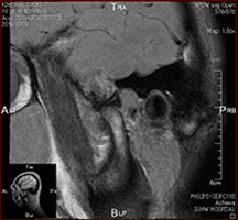 顎関節 MRI (開口時)01