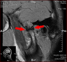 顎関節 MRI (開口時)01