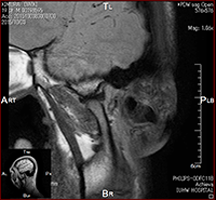 顎関節 MRI (開口時)02