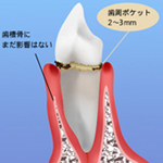 段階 1 軽度歯周炎（歯周ポケットの深さ：2～3mm）